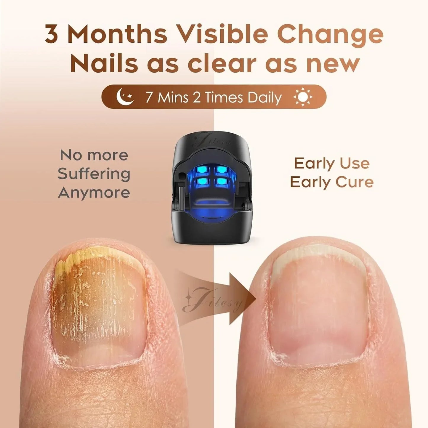 Nail Fungus Treatment LED Laser Device for Cleaning Onychomycosis USB Charge 905nm Infrared Light 470nm Blue Light Nail Salon